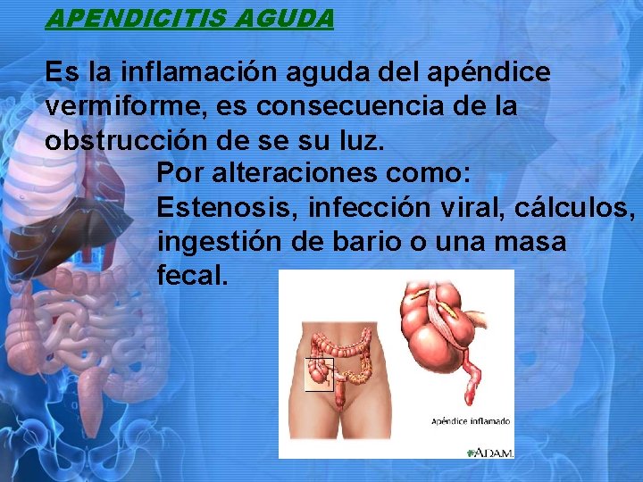 APENDICITIS AGUDA Es la inflamación aguda del apéndice vermiforme, es consecuencia de la obstrucción