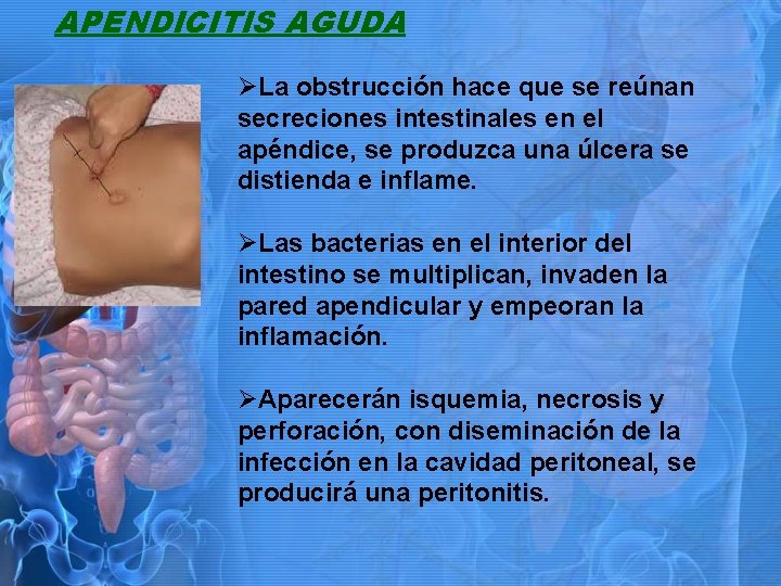 APENDICITIS AGUDA ØLa obstrucción hace que se reúnan secreciones intestinales en el apéndice, se