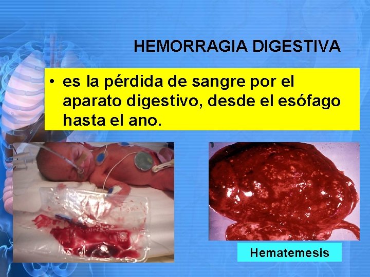 HEMORRAGIA DIGESTIVA • es la pérdida de sangre por el aparato digestivo, desde el