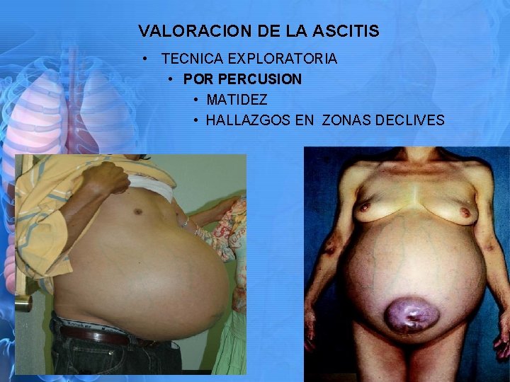 VALORACION DE LA ASCITIS • TECNICA EXPLORATORIA • POR PERCUSION • MATIDEZ • HALLAZGOS