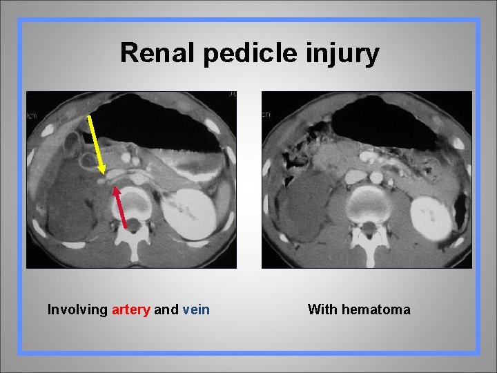 Renal pedicle injury Involving artery and vein With hematoma 