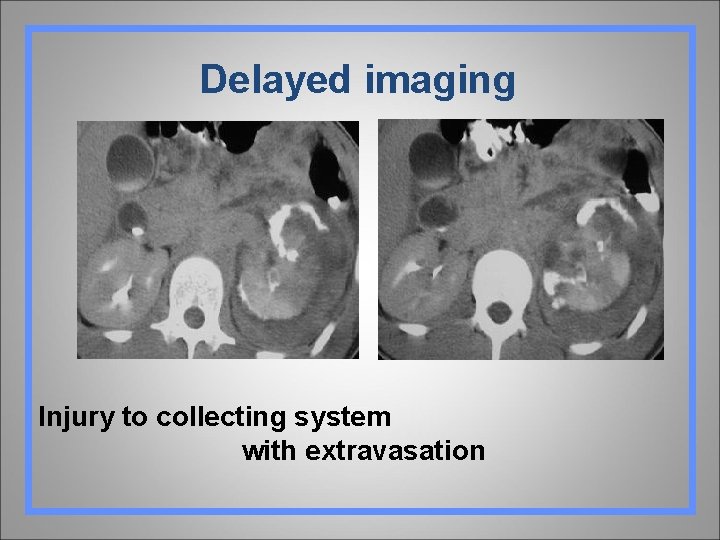 Delayed imaging Injury to collecting system with extravasation 