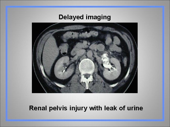 Delayed imaging Renal pelvis injury with leak of urine 