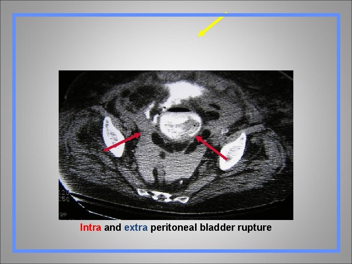 Intra and extra peritoneal bladder rupture 