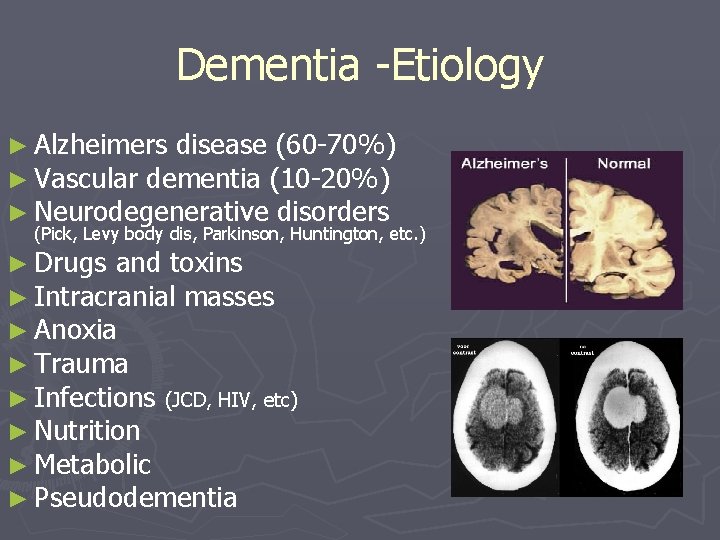Dementia -Etiology ► Alzheimers disease (60 -70%) ► Vascular dementia (10 -20%) ► Neurodegenerative Dementia -Etiology ► Alzheimers disease (60 -70%) ► Vascular dementia (10 -20%) ► Neurodegenerative