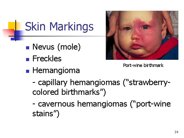 Skin Markings n n n Nevus (mole) Freckles Port-wine birthmark Hemangioma - capillary hemangiomas Skin Markings n n n Nevus (mole) Freckles Port-wine birthmark Hemangioma - capillary hemangiomas