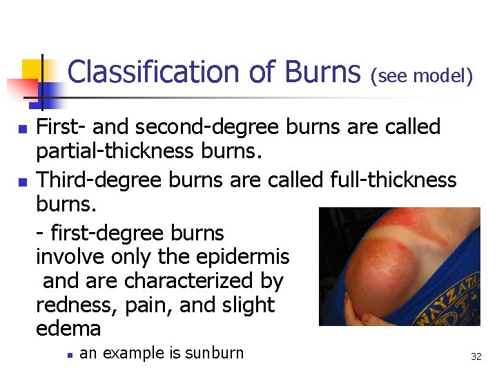 Classification of Burns n n (see model) First- and second-degree burns are called partial-thickness Classification of Burns n n (see model) First- and second-degree burns are called partial-thickness