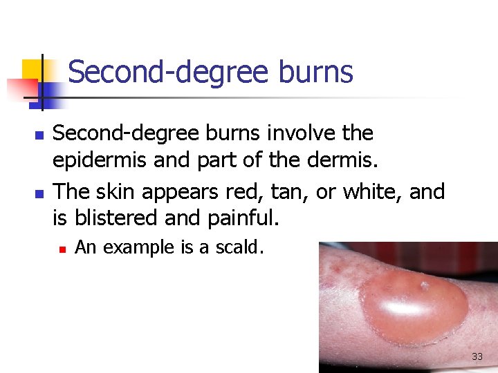 Second-degree burns n n Second-degree burns involve the epidermis and part of the dermis. Second-degree burns n n Second-degree burns involve the epidermis and part of the dermis.