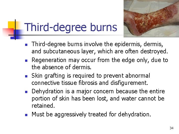 Third-degree burns n n n Third-degree burns involve the epidermis, and subcutaneous layer, which Third-degree burns n n n Third-degree burns involve the epidermis, and subcutaneous layer, which