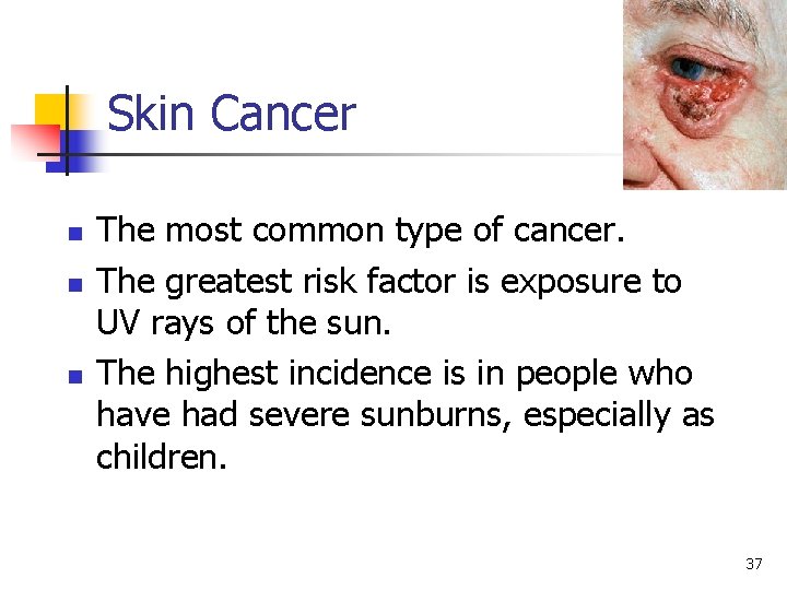 Skin Cancer n n n The most common type of cancer. The greatest risk Skin Cancer n n n The most common type of cancer. The greatest risk