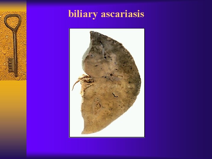 biliary ascariasis 