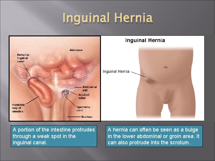 Inguinal Hernia A portion of the intestine protrudes through a weak spot in the