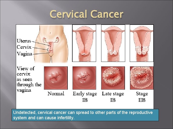 Cervical Cancer Undetected, cervical cancer can spread to other parts of the reproductive system