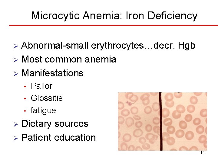 Microcytic Anemia: Iron Deficiency Abnormal-small erythrocytes…decr. Hgb Ø Most common anemia Ø Manifestations Ø