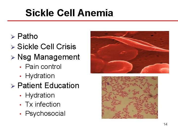 Sickle Cell Anemia Patho Ø Sickle Cell Crisis Ø Nsg Management Ø • •