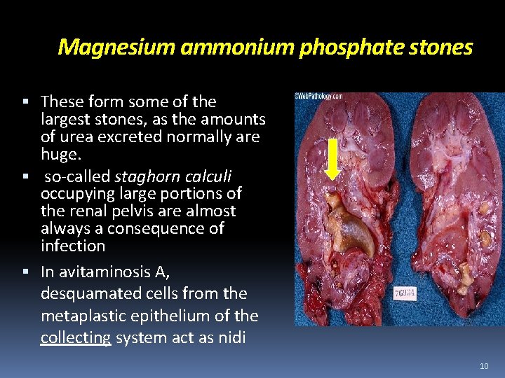 Magnesium ammonium phosphate stones These form some of the largest stones, as the amounts
