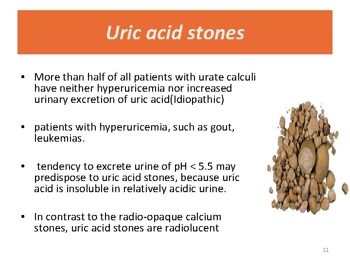 Uric acid stones • More than half of all patients with urate calculi have