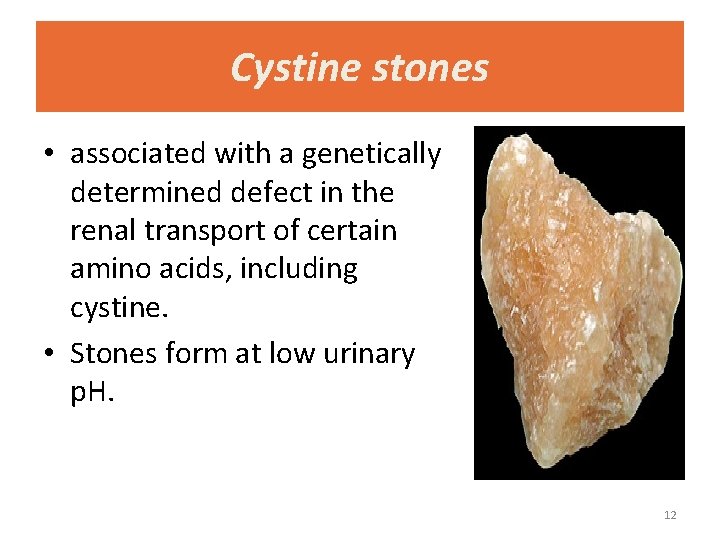 Cystine stones • associated with a genetically determined defect in the renal transport of