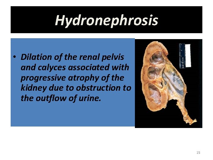 Hydronephrosis • Dilation of the renal pelvis and calyces associated with progressive atrophy of