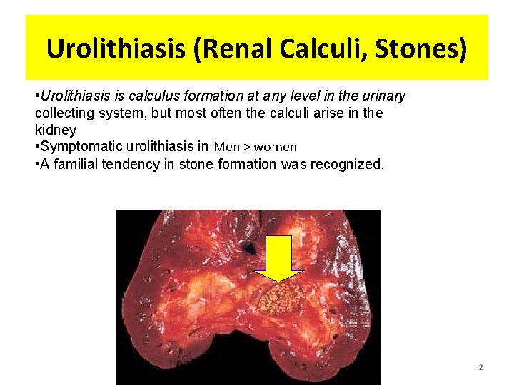 Urolithiasis (Renal Calculi, Stones) • Urolithiasis is calculus formation at any level in the