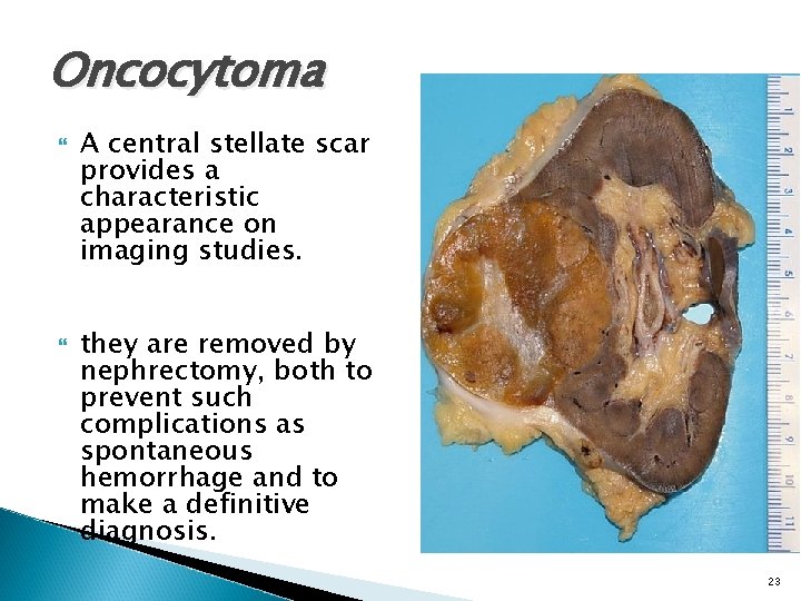 Oncocytoma A central stellate scar provides a characteristic appearance on imaging studies. they are