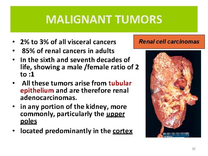 MALIGNANT TUMORS Renal cell carcinomas • 2% to 3% of all visceral cancers •