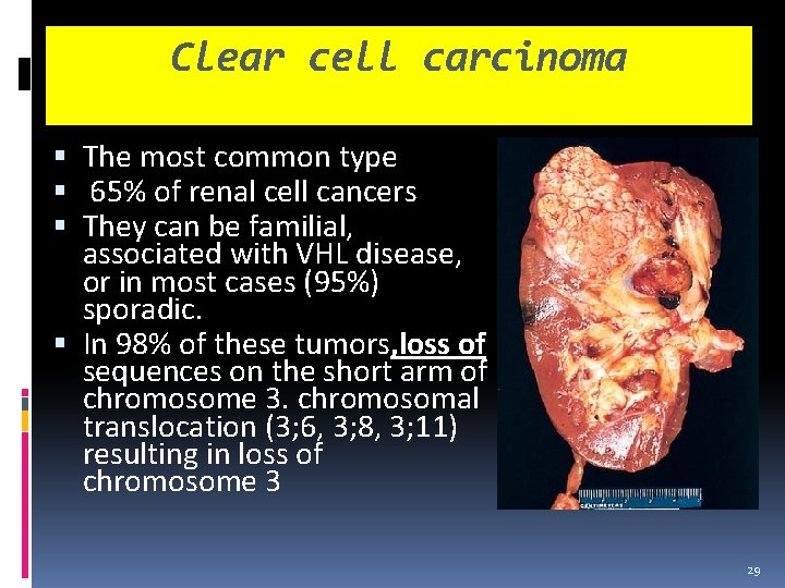 Clear cell carcinoma The most common type 65% of renal cell cancers They can