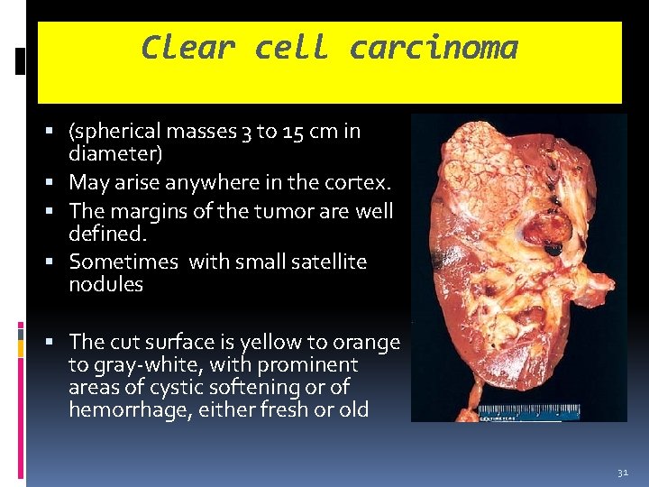 Clear cell carcinoma (spherical masses 3 to 15 cm in diameter) May arise anywhere