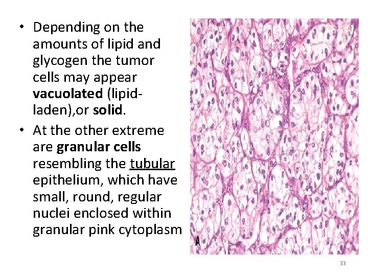  • Depending on the amounts of lipid and glycogen the tumor cells may