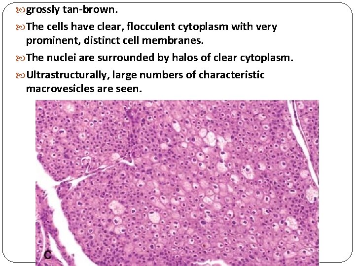  grossly tan-brown. The cells have clear, flocculent cytoplasm with very prominent, distinct cell