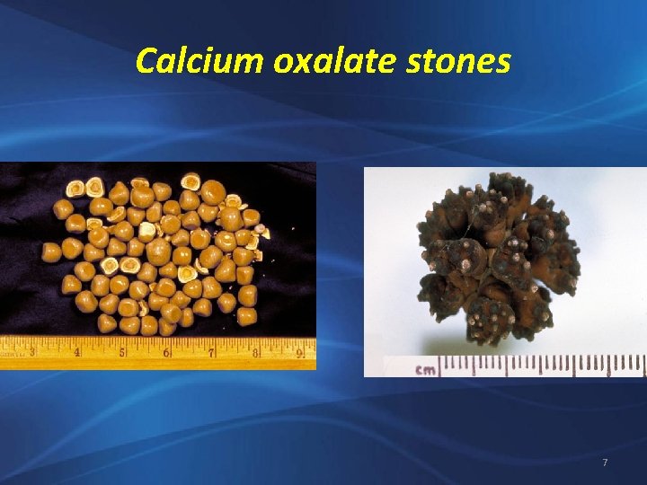 Calcium oxalate stones 7 