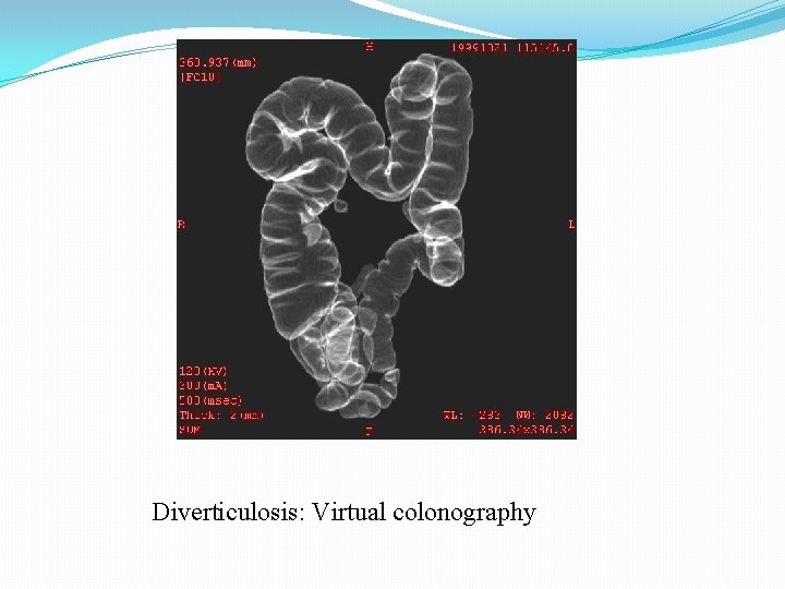 Diverticulosis: Virtual colonography 