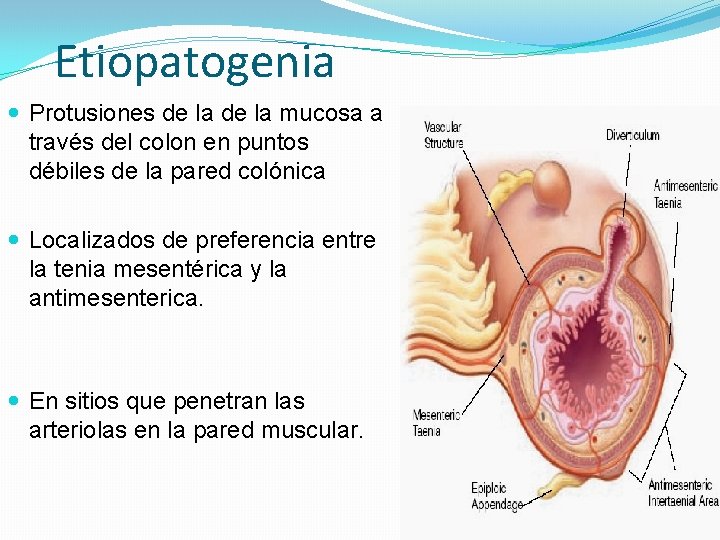 Etiopatogenia Protusiones de la mucosa a través del colon en puntos débiles de la