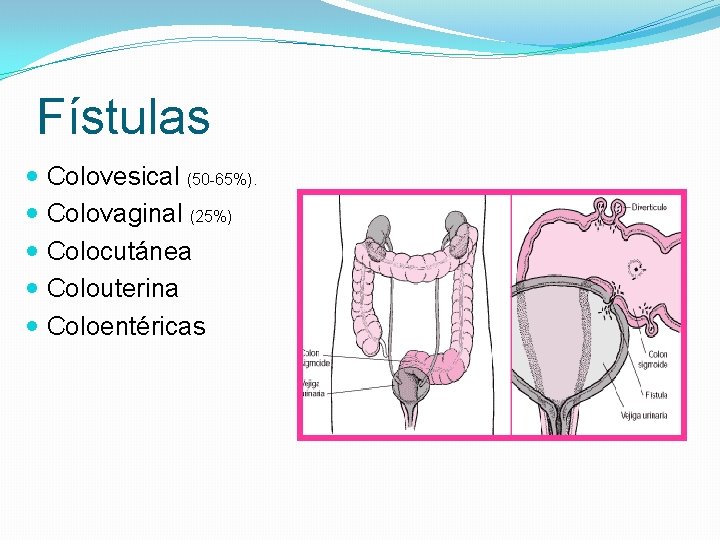 Fístulas Colovesical (50 -65%). Colovaginal (25%) Colocutánea Colouterina Coloentéricas 