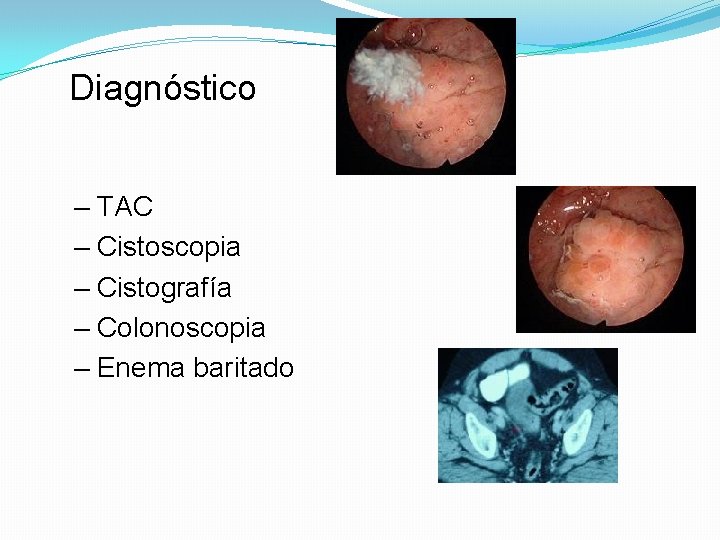 Diagnóstico – TAC – Cistoscopia – Cistografía – Colonoscopia – Enema baritado 