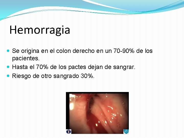 Hemorragia Se origina en el colon derecho en un 70 -90% de los pacientes.