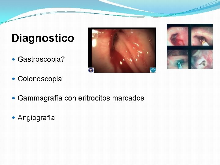 Diagnostico Gastroscopia? Colonoscopia Gammagrafía con eritrocitos marcados Angiografía 