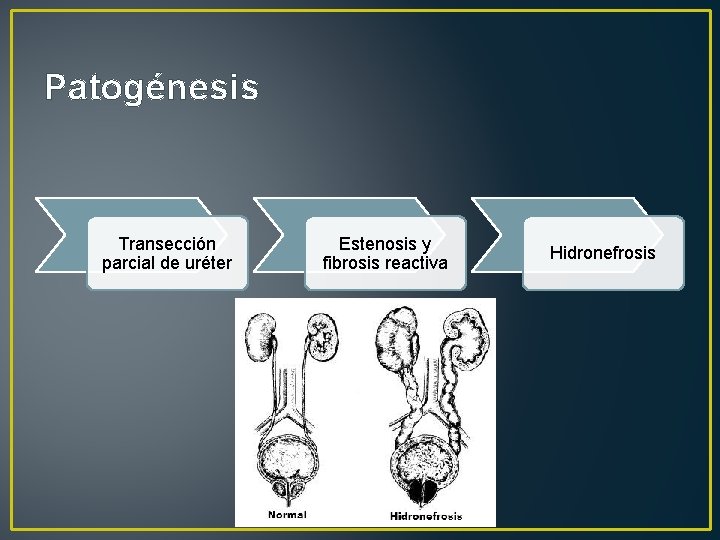 Patogénesis Transección parcial de uréter Estenosis y fibrosis reactiva Hidronefrosis 