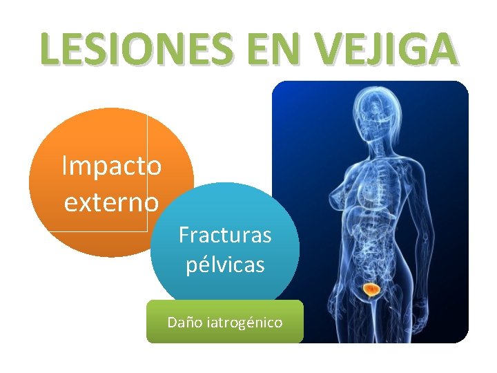 LESIONES EN VEJIGA Impacto externo Fracturas pélvicas Daño iatrogénico 