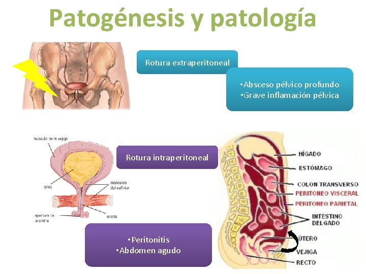 Patogénesis y patología Rotura extraperitoneal • Absceso pélvico profundo • Grave inflamación pélvica Rotura