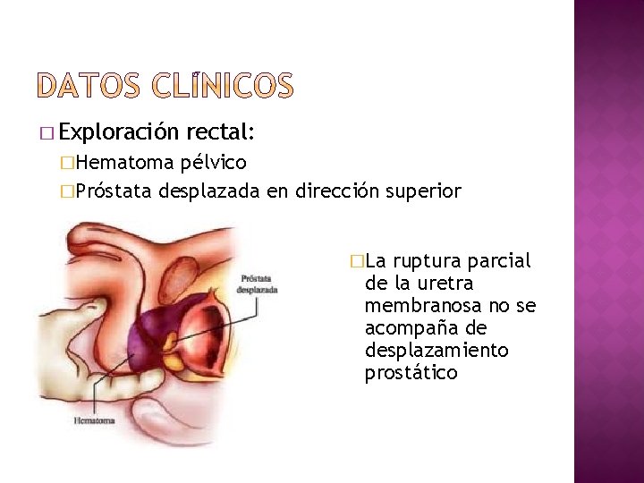 � Exploración rectal: �Hematoma pélvico �Próstata desplazada en dirección superior �La ruptura parcial de