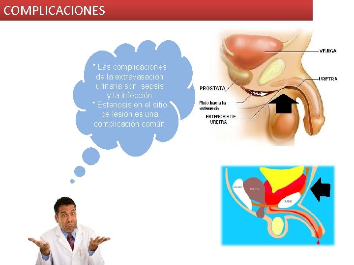 COMPLICACIONES * Las complicaciones de la extravasación urinaria son sepsis y la infección *