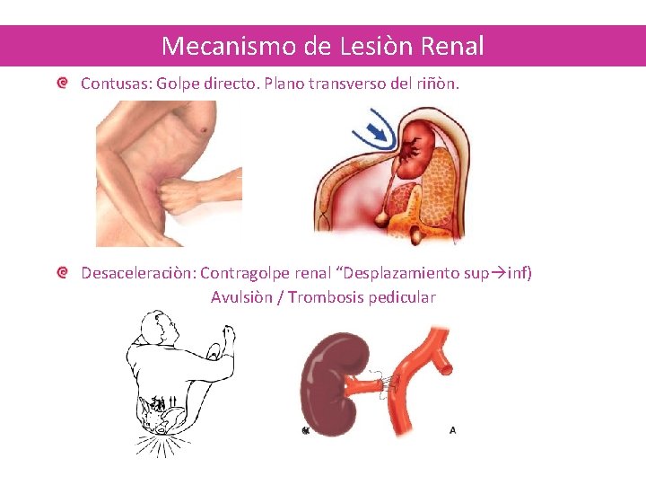 Mecanismo de Lesiòn Renal Contusas: Golpe directo. Plano transverso del riñòn. Desaceleraciòn: Contragolpe renal