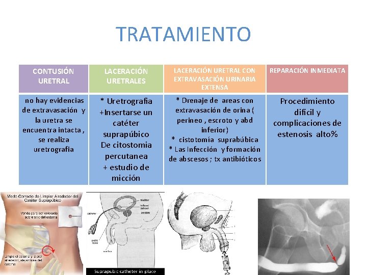 TRATAMIENTO CONTUSIÓN URETRAL LACERACIÓN URETRALES LACERACIÓN URETRAL CON EXTRAVASACIÓN URINARIA EXTENSA REPARACIÓN INMEDIATA no