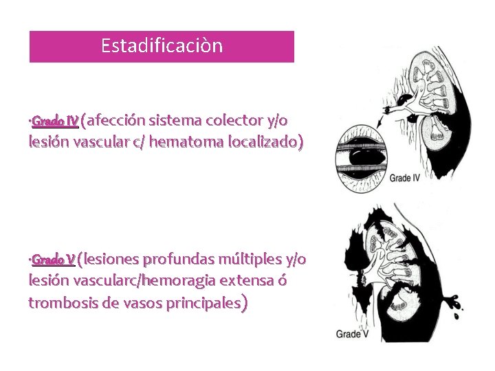 Estadificaciòn • Grado IV (afección sistema colector y/o lesión vascular c/ hematoma localizado) •