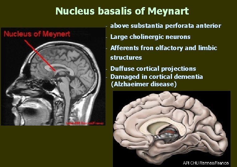 Nucleus basalis of Meynart - above substantia perforata anterior - Large cholinergic neurons -
