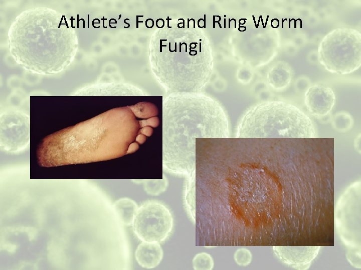 Athlete’s Foot and Ring Worm Fungi 