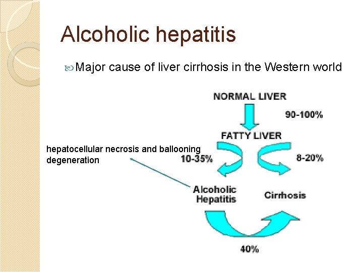 Alcoholic hepatitis Major cause of liver cirrhosis in the Western world hepatocellular necrosis and