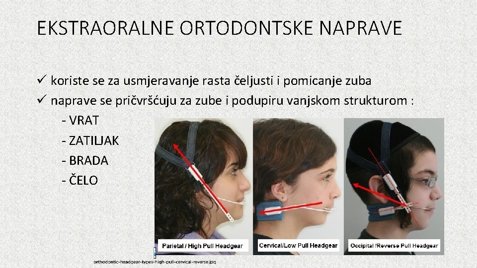 EKSTRAORALNE ORTODONTSKE NAPRAVE ü koriste se za usmjeravanje rasta čeljusti i pomicanje zuba ü