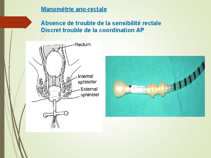 Manométrie ano-rectale Absence de trouble de la sensibilité rectale Discret trouble de la coordination